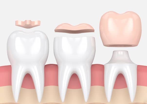 Inlays and Onlays in Los Angeles, CA - Westwood Dental Esthetics